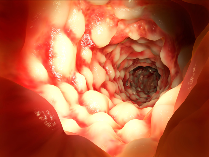 Crohn y alimentación Crohn