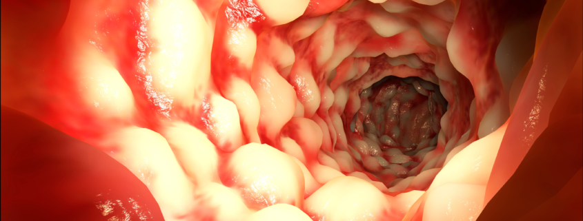 Crohn